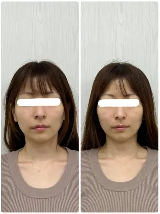 美容鍼×小顔矯正 ×美容整体　浜川泰仁のエステ・リラクイメージ