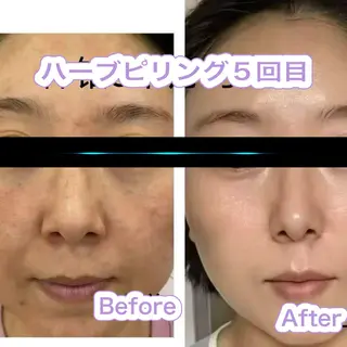【ハイパーナイフ痩身&小顔コルギ&ハーブピーリング】K-Beauty　東新宿所属・kーbeauty痩身 フェイシャルのエステ・リラクイメージ