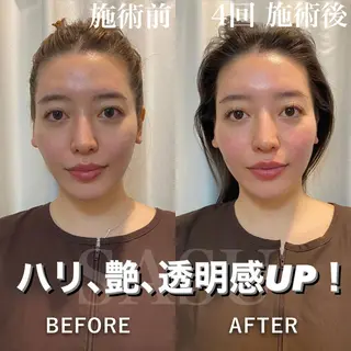 メンズ 即小顔♥️美容鍼× ハーブピーリングのその他イメージ