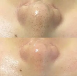 毛穴レス美肌へ🌿 看護師Abe🌼のエステ・リラクイメージ