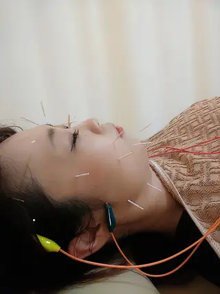 リフトアップ・たるみ ☆美容鍼小顔矯正のその他イメージ