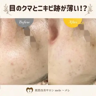 ニキビ/毛穴改善専門 サロンつくば🌈森園のエステ・リラクイメージ