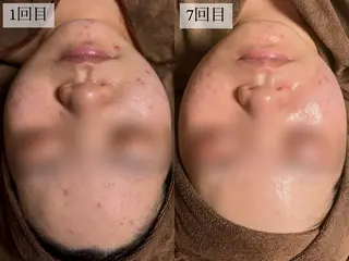 HINANO矢場町店【ヒナノ】所属・脱毛/肌改善🌿 HINANO 村田のエステ・リラクイメージ