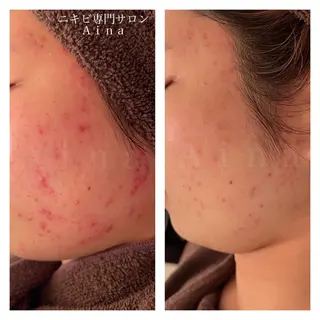 ショート パーマ ヘアアレンジ メンズ キッズ ネイル マツエク・マツパ アイブロウ ニキビ跡専門サロン Ainaのエステ・リラクイメージ