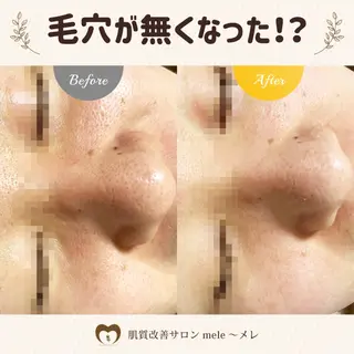 ニキビケア/毛穴/ 赤み/自信の肌✨森園のエステ・リラクイメージ