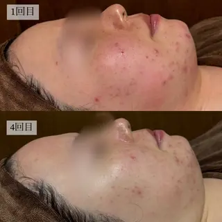 HINANO矢場町店【ヒナノ】所属・脱毛/肌改善🌿 HINANO 村田のエステ・リラクイメージ