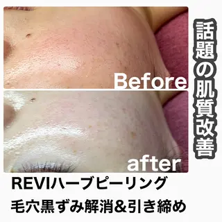 Chalon所属・REVI取扱・肌悩み 改善　Chalonのエステ・リラクイメージ