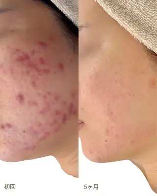 Nicore所属・肌質改善🌿まつ毛 chapiのエステ・リラクイメージ