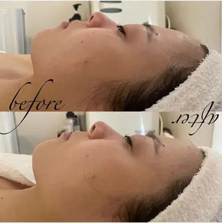 毛穴/ピーリング ララピール/POLAのエステ・リラクイメージ