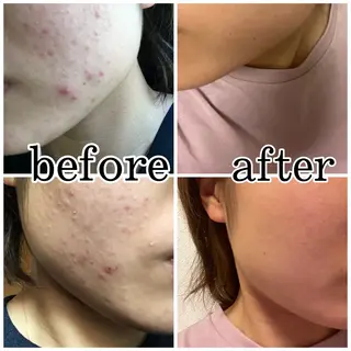 NARIS BEAUTY STATION　デ・アイム あべのルシアス所属・ニキビ跡/毛穴/ 肌質改善/北村ももこのエステ・リラクイメージ