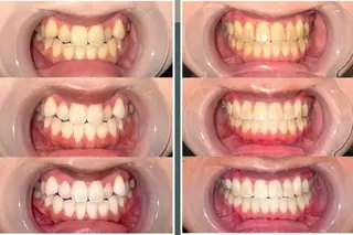 歯のセルフホワイトニング専門店GLOW（グロウ）所属・東区香椎歯のセルフホ ワイトニングGLOWのその他イメージ