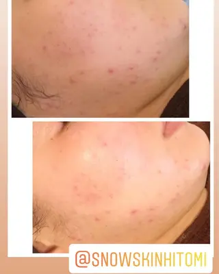 ニキビ/肌質改善専門 Snow skinのエステ・リラクイメージ