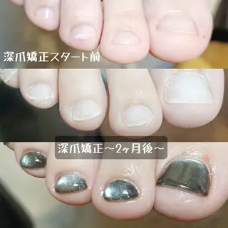 ネイル 深爪矯正/爪育成ケア manie nailのネイルデザイン