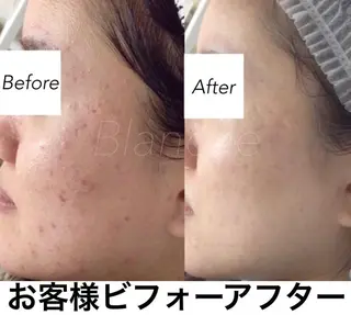 ミディアム カラー パーマ ヘアアレンジ ネイル マツエク・マツパ 都度払い肌質改善 &脱毛Blancheのエステ・リラクイメージ