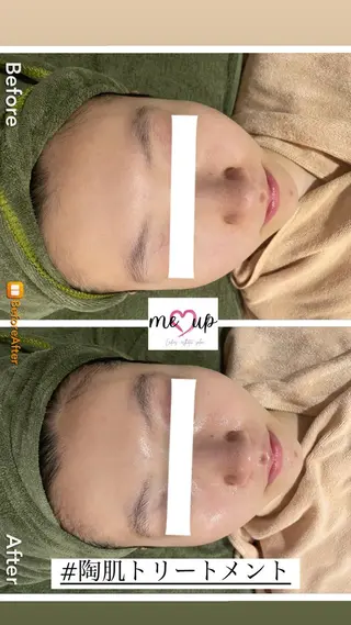 Meupニキビ専門店 背中/ハーブ/ララのその他イメージ