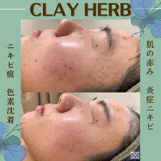 【剥離ありハーブピーリング専門エステ】cerisier BEAUTÉ 原宿所属・cerisier BEAUTÉのエステ・リラクイメージ
