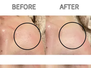 ハーブピーリング LIME池袋東口のエステ・リラクイメージ