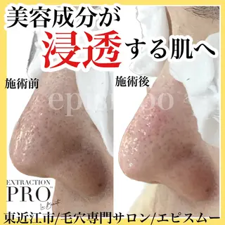 epismoo 脱毛/HBL/毛穴の眉毛・アイブロウイメージ