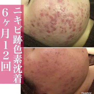 学生ニキビ改善🍀 優しい肌質改善のエステ・リラクイメージ