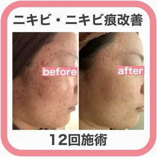 学生ニキビ改善🍀 優しい肌質改善のエステ・リラクイメージ