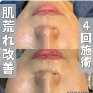 ニキビ・ニキビ跡改善 leoloのエステ・リラクイメージ