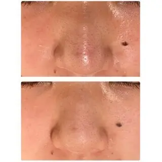 ニキビ跡改善専門🔥 医療にはできない改善のエステ・リラクイメージ