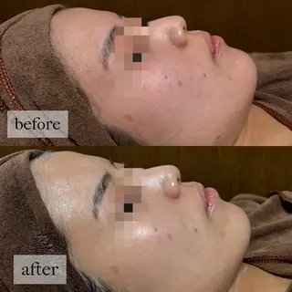 HINANO矢場町店【ヒナノ】所属・脱毛/肌改善🌿 HINANO 村田のエステ・リラクイメージ