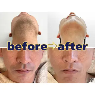 セルフ脱毛/美尻イス キングスサロン熊本のエステ・リラクイメージ