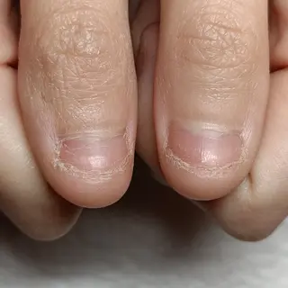 ネイル 深爪矯正/爪育成ケア manie nailのネイルデザイン
