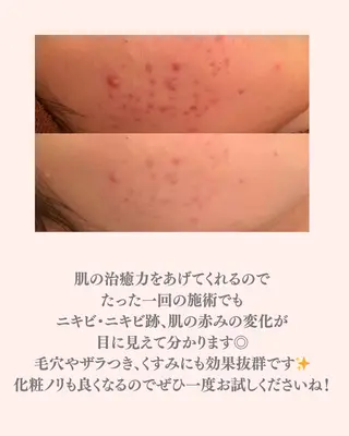 撲滅🔥 最短ニキビ改善のエステ・リラクイメージ