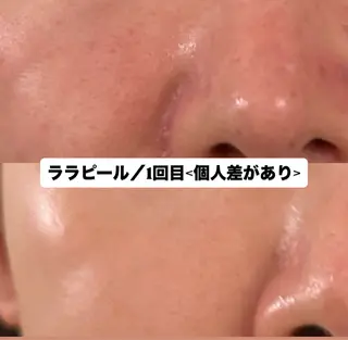 【ハイパーナイフ痩身&小顔コルギ&ハーブピーリング】K-Beauty　東新宿所属・kーbeauty痩身 フェイシャルのエステ・リラクイメージ