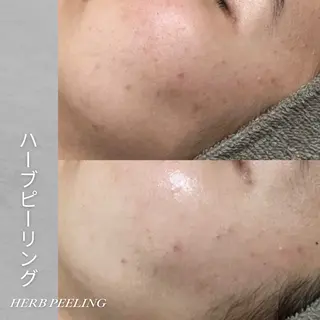 EST BEAUTY所属・顔ワックス脱毛/ ハーブピーリングのエステ・リラクイメージ