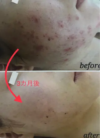 脱毛｜肌質改善｜ ROOM.Sのエステ・リラクイメージ