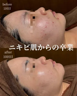 HINANO矢場町店【ヒナノ】所属・脱毛/肌改善🌿 HINANO 村田のエステ・リラクイメージ