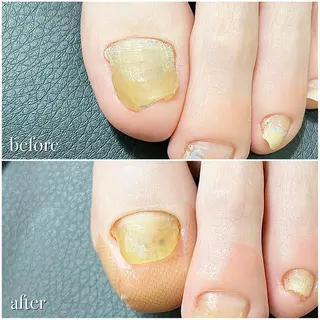 ネイル 深爪・巻き爪 専門サンセリテのネイルデザイン