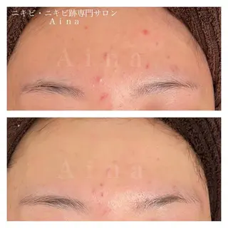 セミロング パーマ ヘアアレンジ メンズ キッズ ネイル マツエク・マツパ アイブロウ ニキビ跡専門サロン Ainaのエステ・リラクイメージ