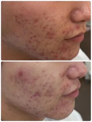 デ・アイム　西船橋所属・吉永玲奈 ニキビ/毛穴/シミのエステ・リラクイメージ