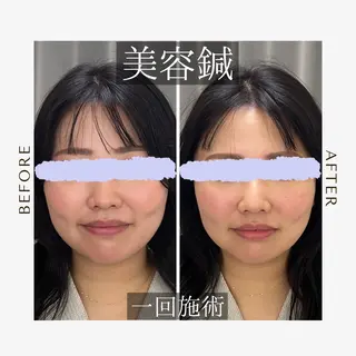 鍼灸•マッサージサロンCalfa所属・《美肌･小顔》美容鍼 ＆マッサージ＊MEIのエステ・リラクイメージ