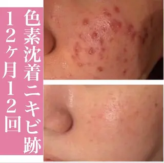 学生ニキビ改善🍀 優しい肌質改善のエステ・リラクイメージ