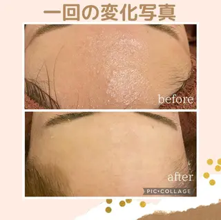 学生ニキビ改善🍀 優しい肌質改善のエステ・リラクイメージ