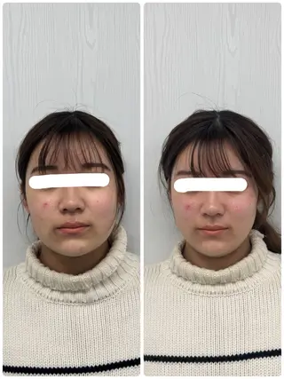 美容鍼×小顔矯正 ×美容整体 浜川泰仁のエステ・リラクイメージ