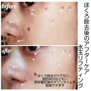 【ニキビ/肌管理】 salon varyのエステ・リラクイメージ