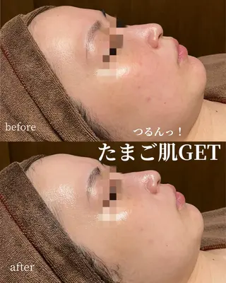 HINANO矢場町店【ヒナノ】所属・脱毛/肌改善🌿 HINANO 村田のエステ・リラクイメージ