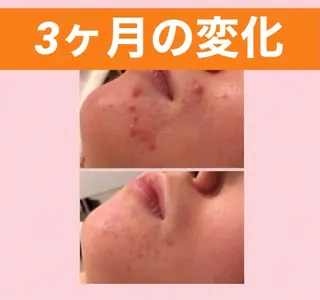 メンズ キッズ ニキビ 専門のエステ・リラクイメージ