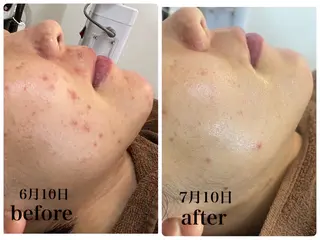 Total beauty salon Dune所属・ニキビ・肌質改善 サロンDuneのエステ・リラクイメージ