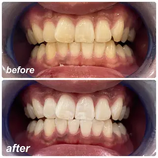 White Berry SELF BEAUTY SALON所属・セルフホワイトニング 🦷口元垢抜け✨のその他イメージ