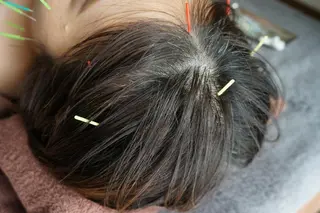 即効⚡小顔美容鍼🪡 むくみたるみ脂肪解消のエステ・リラクイメージ