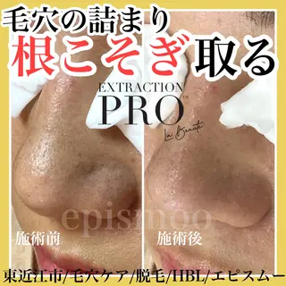 epismoo 脱毛/HBL/毛穴の眉毛・アイブロウイメージ