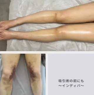 インディバ術後 痩身🔥 ヨコヤマのエステ・リラクイメージ