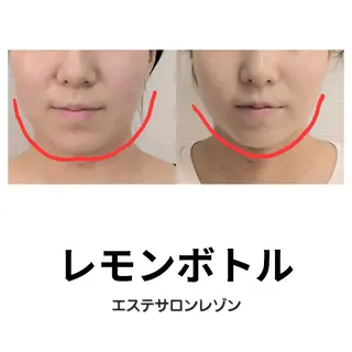 ニキビケア＆ニキビ跡 レゾン京橋店　のエステ・リラクイメージ